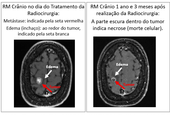 Câncer de Mama em paciente jovem