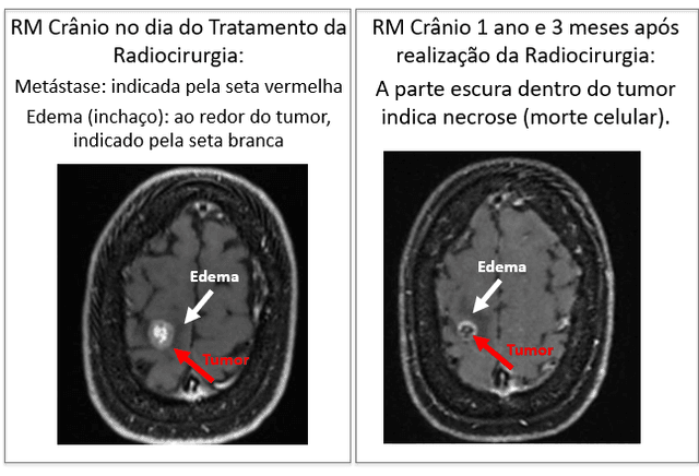 Câncer de Mama em paciente jovem
