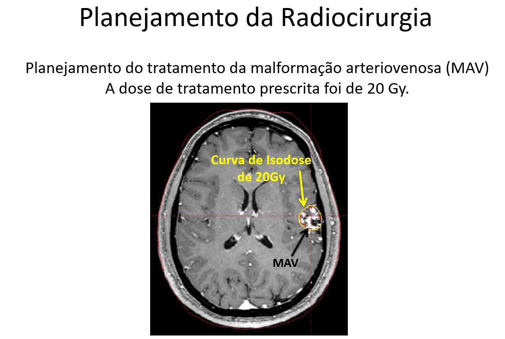 Dor de cabeça secundária à MAV