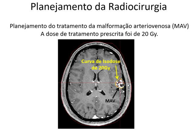 Dor de cabeça secundária à MAV