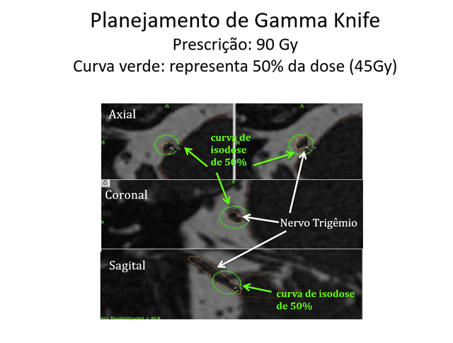 Dor Facial - Neuralgia Trigeminal Essencial