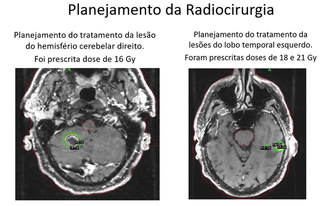 Múltiplas Metástases Cerebrais decorrentes de Carcinoma do Estômago