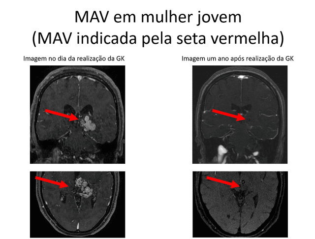 Malformação árterio-venosa pós-sangramento
