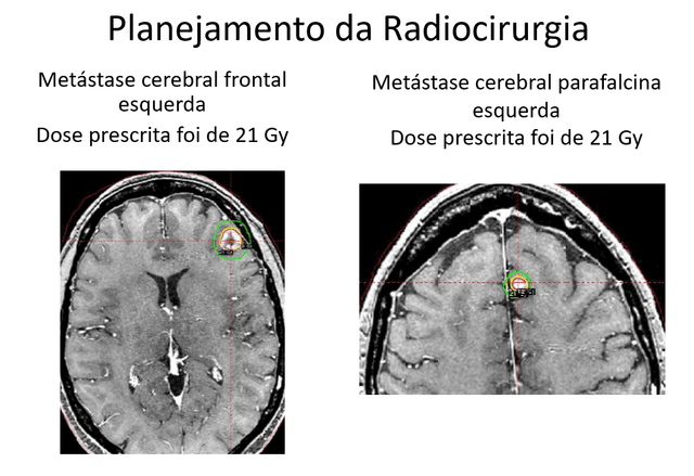 Metástase Cerebral de Câncer de Mama
