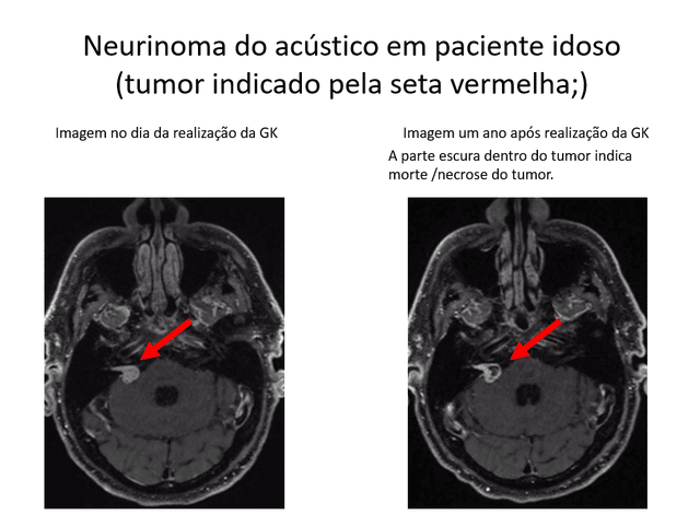 Neurinoma do acústico em paciente idoso