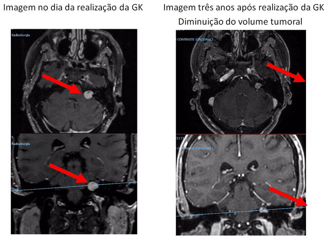 Neurinoma do acústico recidivado