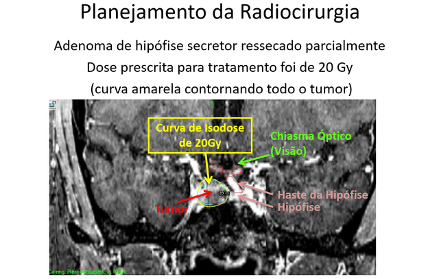 Paciente com Acromegalia