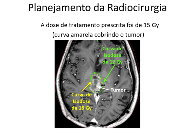 Raro Tumor da região Pineal em criança