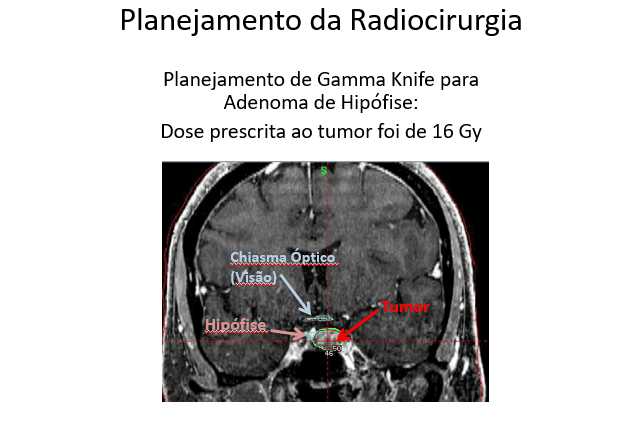 Tumor de Hipófise Não-Secretor