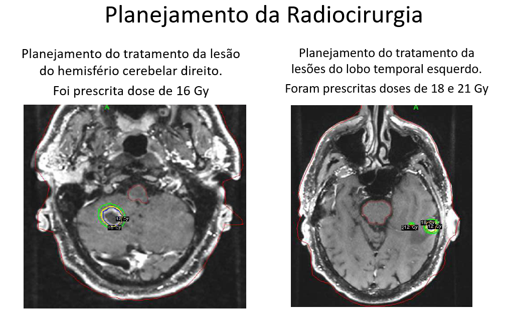 múltiplas-metástases-cerebrais-decorrentes-de-carcinoma-do-estômago-1.png